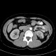 Renal cyst, complicated cyst: CT - Computed tomography